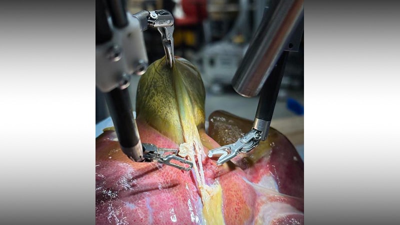 عمل جراحی بدون دخالت انسان؛ ربات هوشمند چگونه عمل برداشت کیسه صفرا را انجام داد