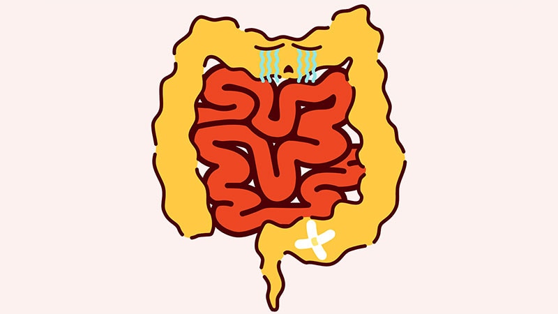 تأثیر وضعیت دیابت نوع 2 بر الگوهای درمان و نتایج بیماری کرون
