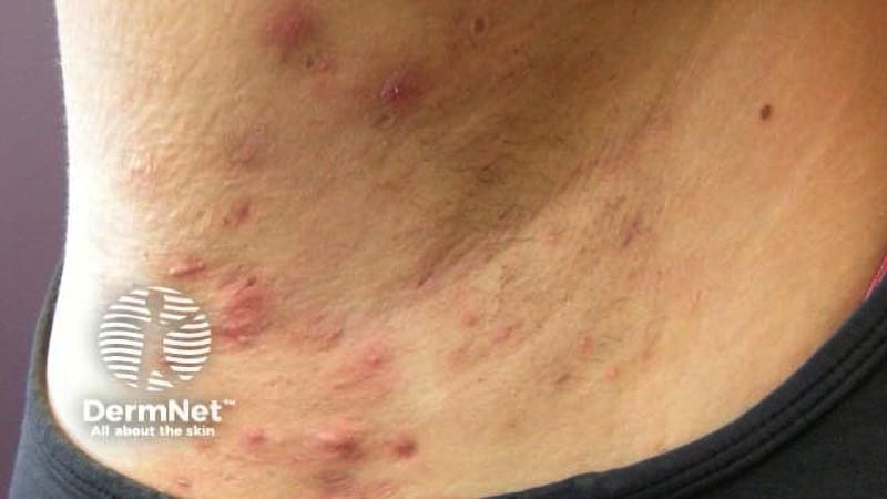 شیوع جهانی هیدرادنیت سوپوراتیو نزدیک به 1 درصد است