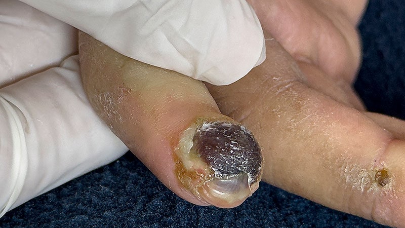 زخم‌های اسکلرودرمی با وجود مراقبت تخصصی به کندی بهبود می‌یابند