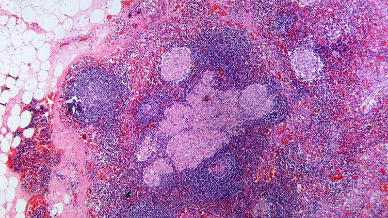 تشخیص زودهنگام سرطان حلق با تست خونی HPV