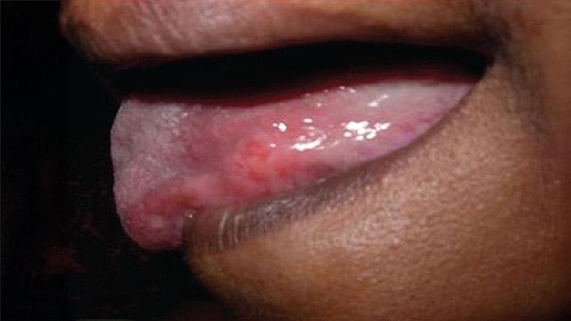 چه کسانی از شیمی‌درمانی همراه با پرتودرمانی در مراحل ابتدایی سرطان حلق بهره‌مند می‌شوند؟