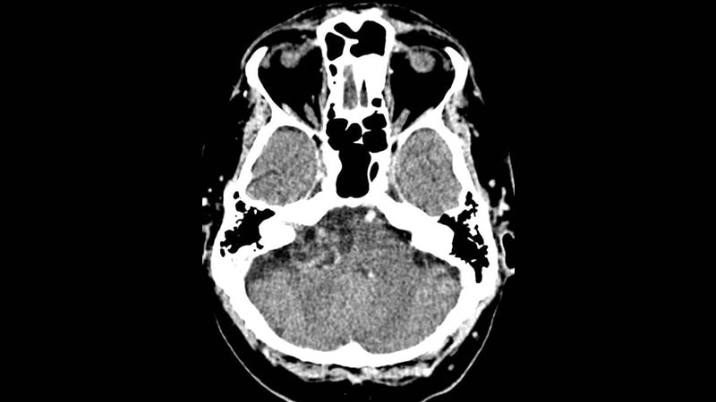 رادیوتراپی کنترل تومورهای فعال وستیبولار اشوانوما را ممکن می‌سازد