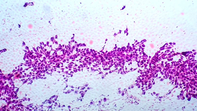 عدم تاثیر کرزوتینیب در درمان جراحی شده ALK+NSCLC مرحله اولیه