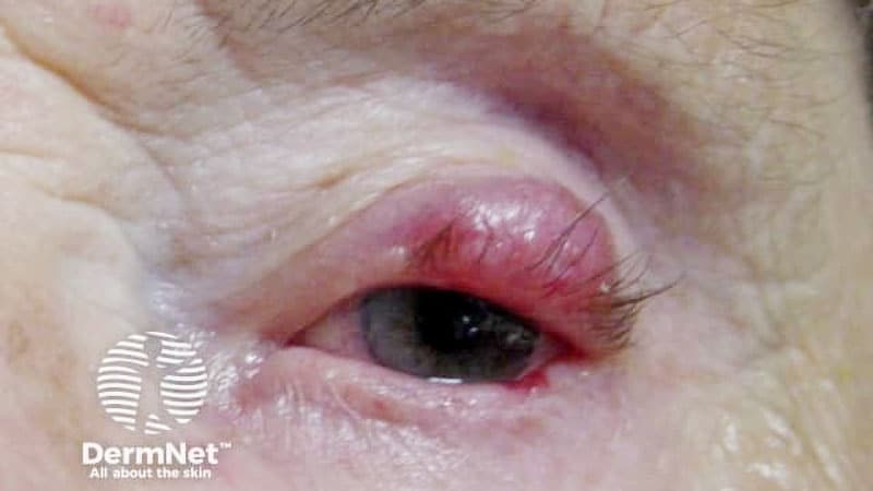 تست آنتی‌بادی پلیوماویروس قادر به پیش‌بینی عود سرطان Merkel Cell