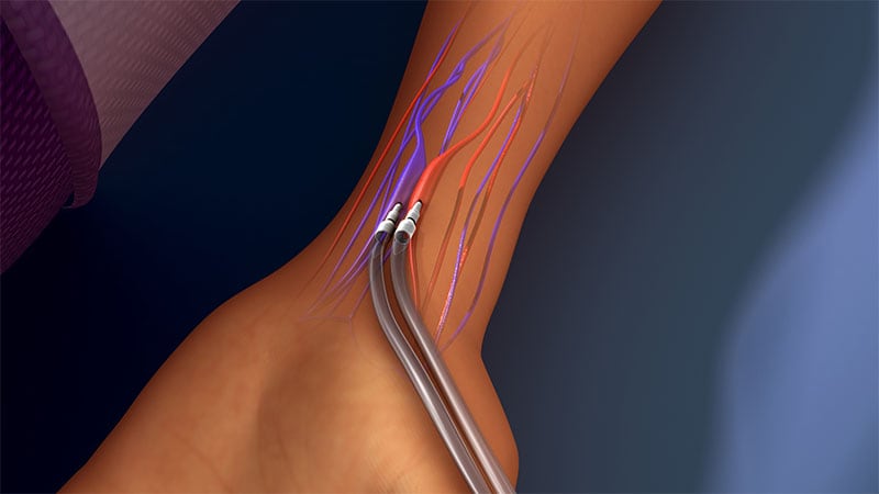 تاثیر کمبودهای مراقبت پیش از دیالیز بر دسترسی عروقی بیماران هیسپانیک