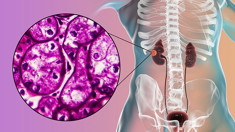 رادیوتراپی، تاخیر در شروع درمان سیستمیک برای سرطان کلیه اولیگومتاستاتیک